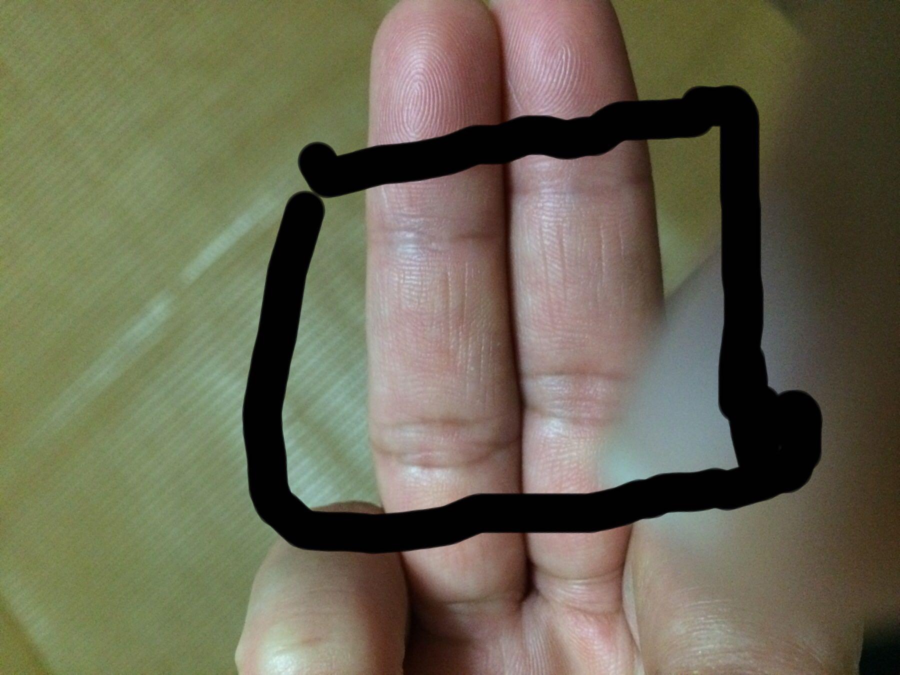妈妈右手这块总是<em>发青</em>!时常感到手发麻!妈妈根