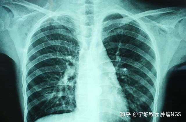 x线可以查出中晚期肺癌,但是表现为磨玻璃样结节的早期肺癌用胸片筛查