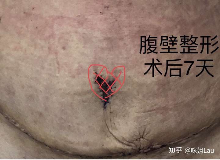 三年前做的剖腹产二胎,肚子上的赘肉不堪入目.是不是必须做腹壁整形?