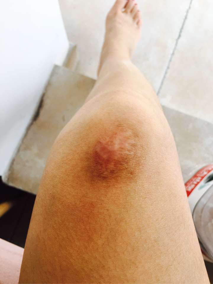 这是两年前从摩托车上掉下来摔伤的膝盖,当时很深的伤口.
