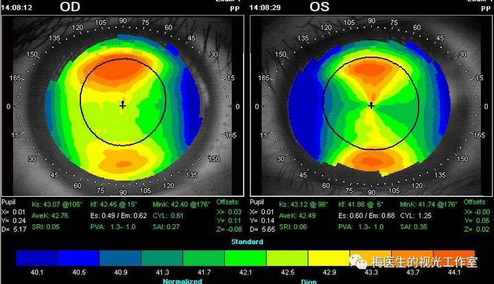 角膜地形图仪清楚地显示角膜表面的高低不平