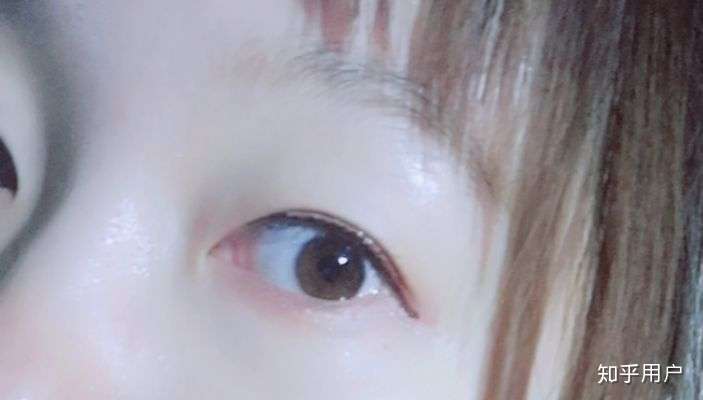 眼睛高度近视,凸出,很肿,请问如何改善?