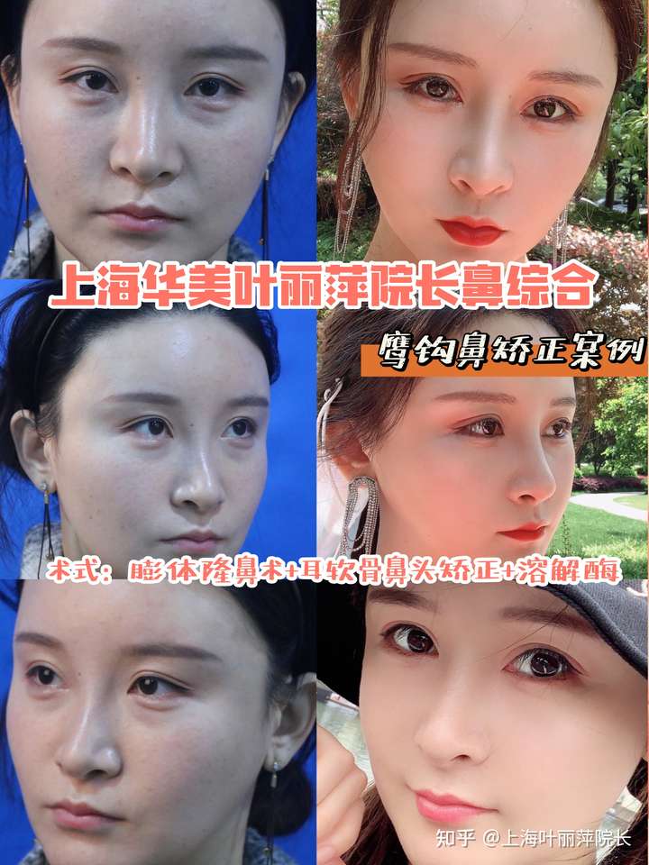 鹰钩鼻真的好丑,有谁回答一下鹰钩鼻要怎么矫正吗?