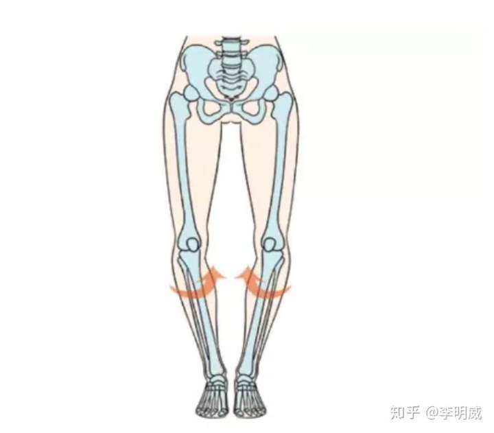 "o型腿"除了腿形不好看之外,这些问题更应该引起重视!