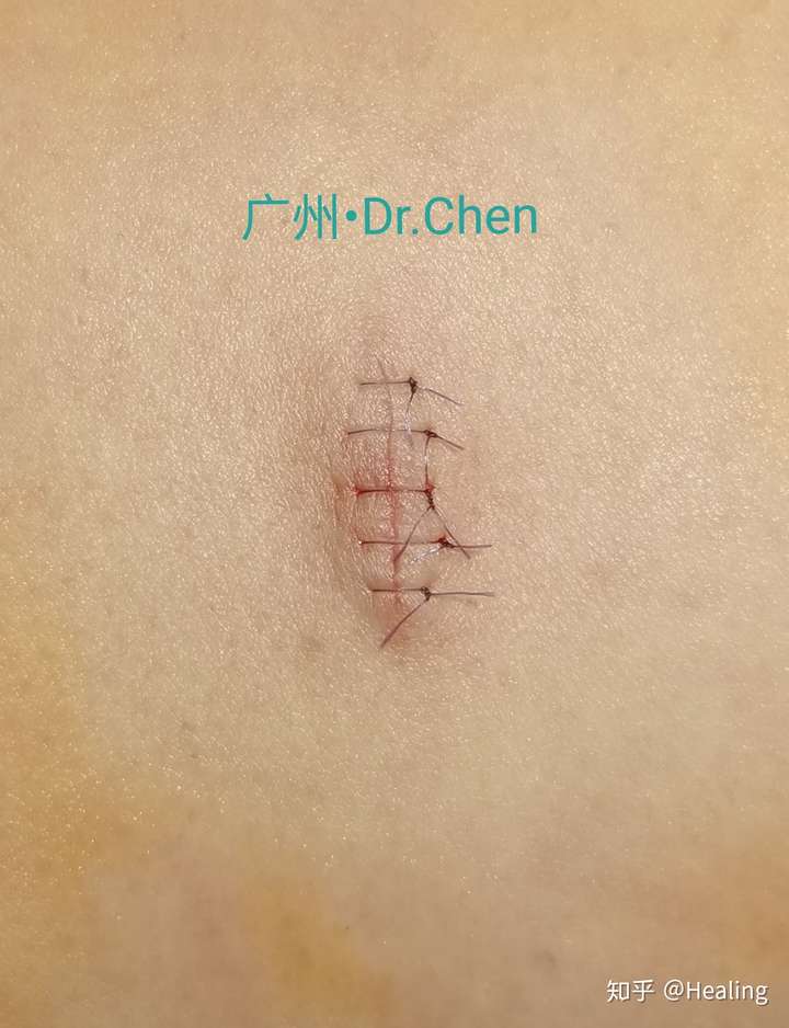 体表肿物切除 改良减张精细美容缝合