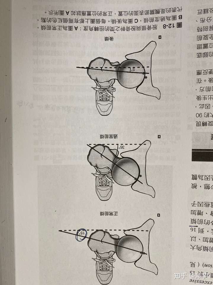 请问,六岁孩子内八字,双髋关节内旋70,该怎么矫正?