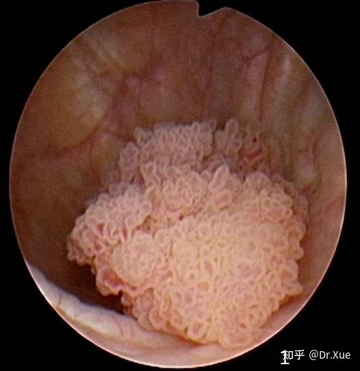 膀胱镜下"菜花样"的膀胱癌