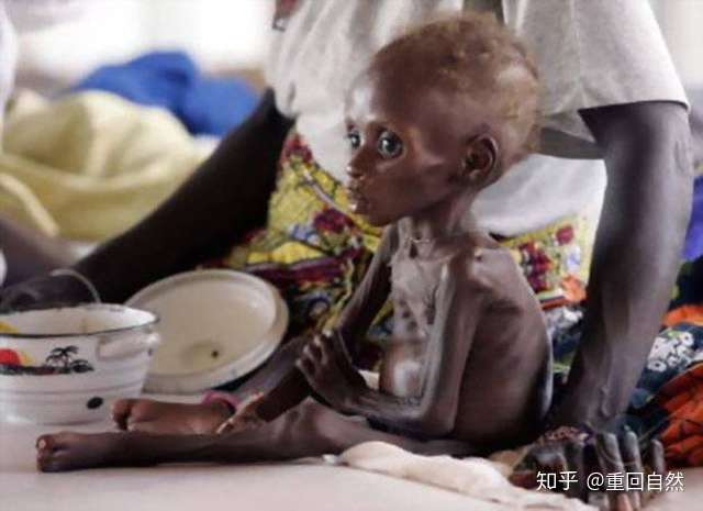 营养不良的非洲儿童(来源于网络)