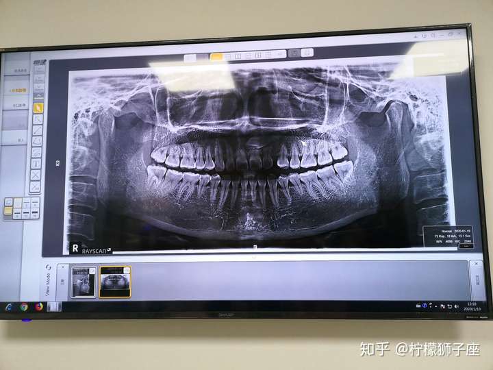这样的上颌埋伏牙,拔出难度大吗?风险呢?
