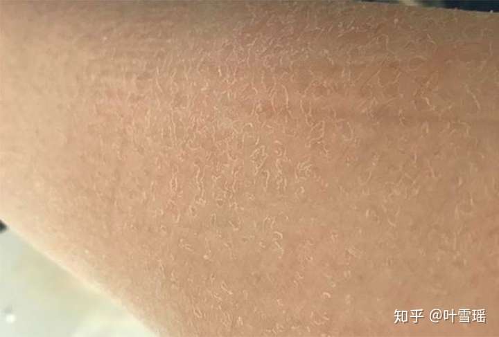 为什么一到冬天,脸上,身上干燥起皮掉皮屑?怎样科学的补水护肤?
