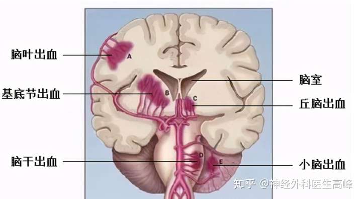 跪求脑干出血有什么好的建议