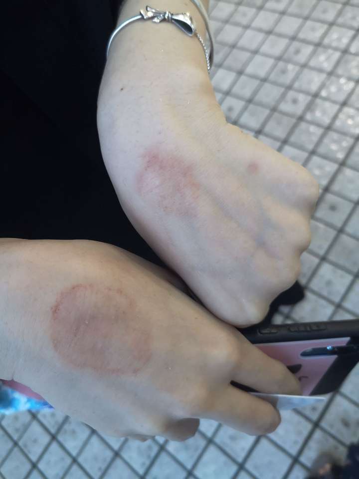 但有一天我突然发现她手背上有一块像 灼烧过的痕迹,很明显,颜色很深