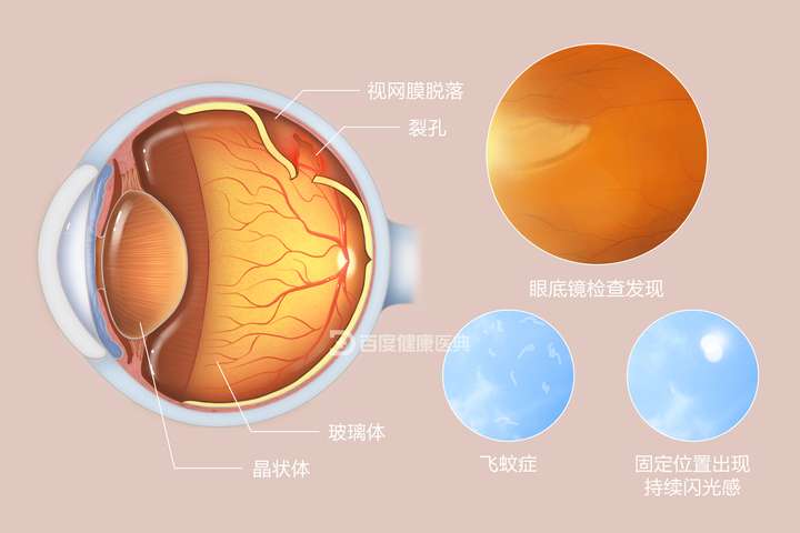 对于严重影响视力,黄斑区的视网膜裂孔,并且伴有玻璃体液化及视网膜
