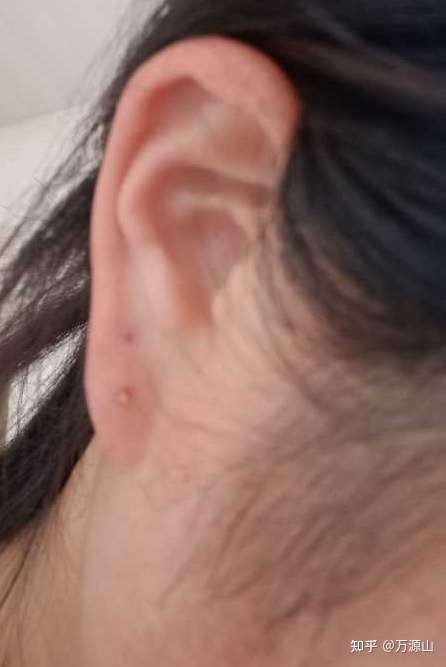 一个血痂黄的东西 就是图上那个小点点,是我愈合的那个耳洞表面的血痂