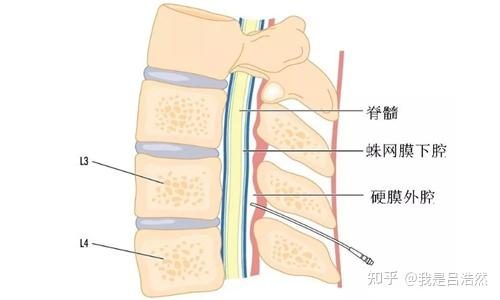 压迫硬膜囊不一定会造成压迫神经,神经是否受压是从患者的症状来判断