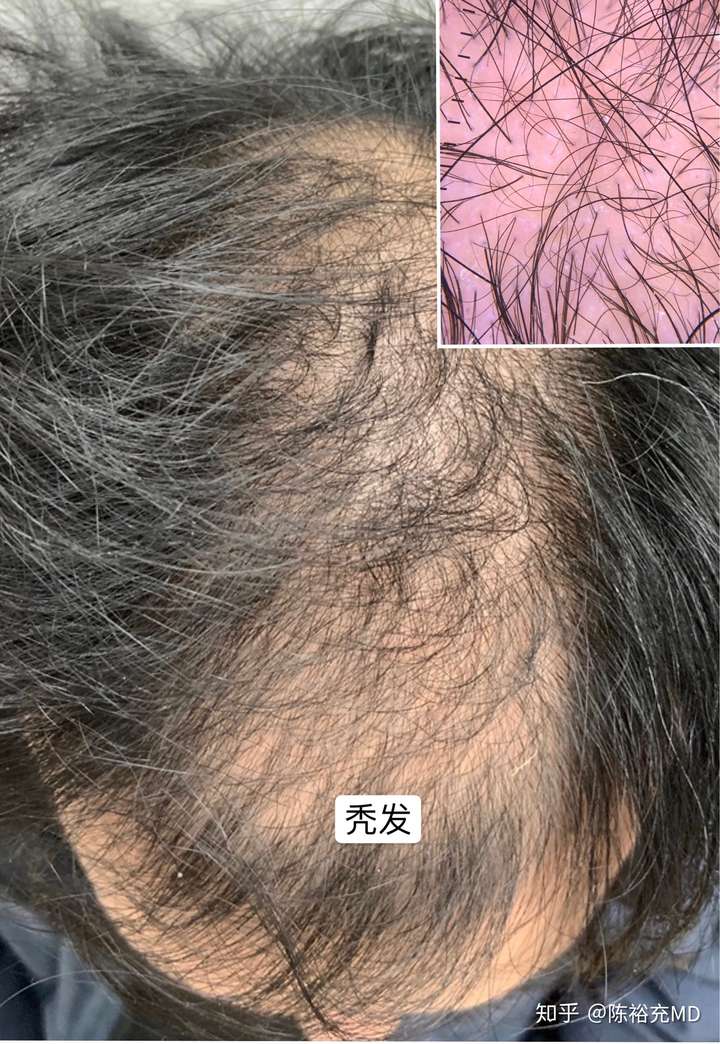 陈裕充md 67 上海市皮肤病医院皮肤外科医师 秃发与脱发还洒洒的分