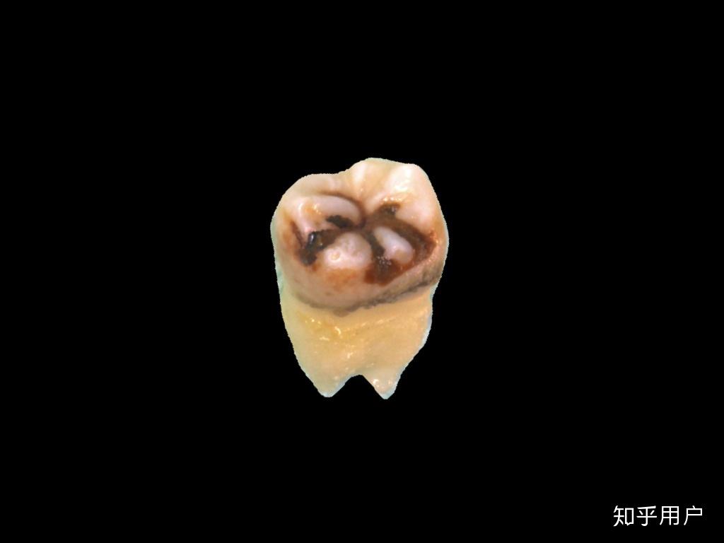 这是一个从病人身上拔下来的牙齿,它就是一个附着着大量牙结石的牙齿.