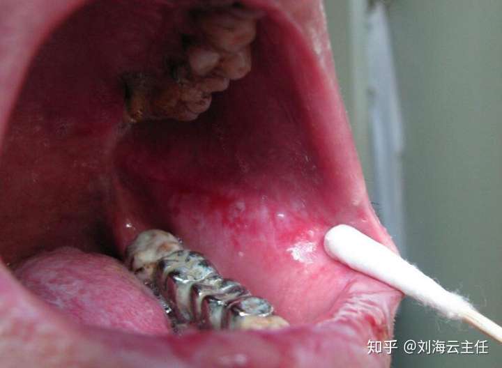 口腔扁平苔藓的症状有哪些?