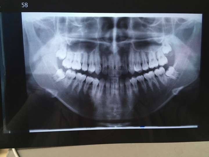 拔智齿有多痛?