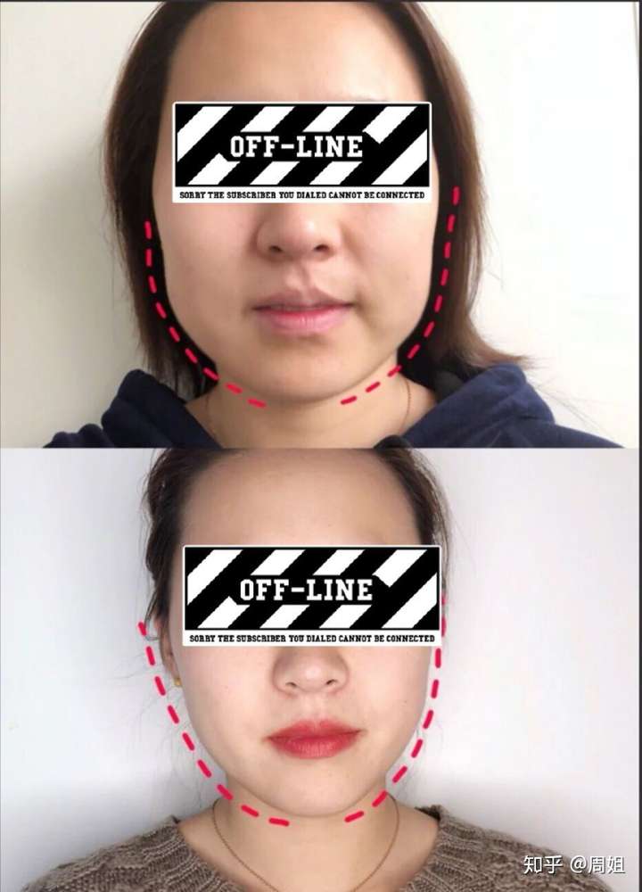 第一:咬肌肥大型