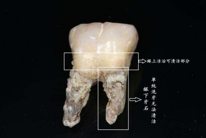 牙结石清除,有效清除牙结石方法,怎样去除牙