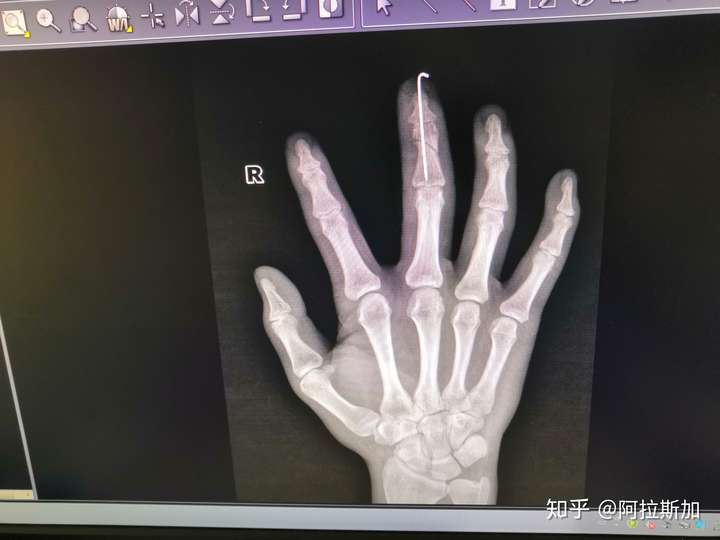 手指头骨折是种怎样的体验