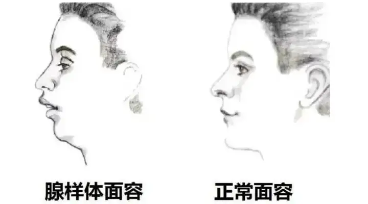 专家介绍,长期张嘴呼吸易致面容变丑,怎么从科学角度解释?