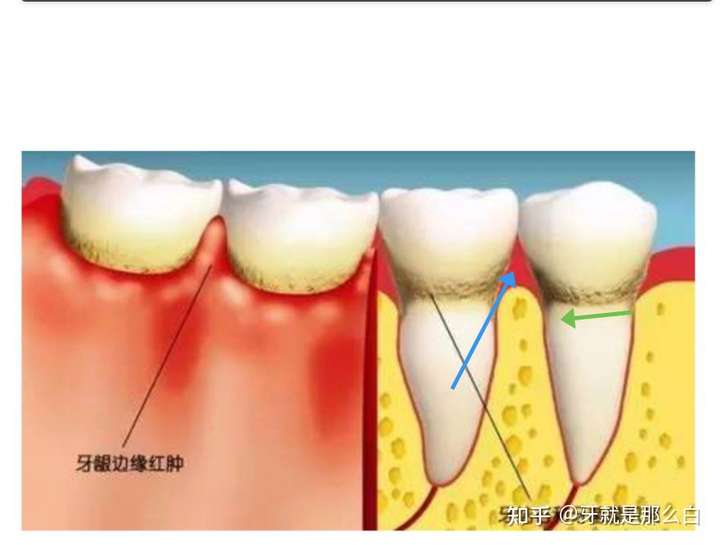 绿色箭头指向的即是牙周膜的位置,当有牙周炎后,这个牙周膜就会增宽