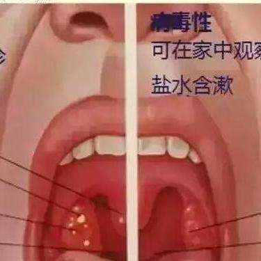 咽峡炎