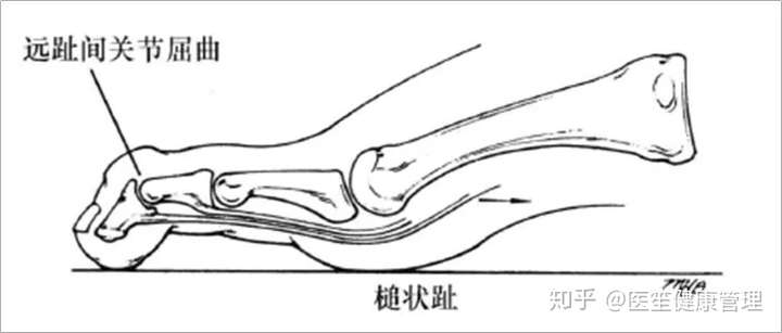 常穿窄头高跟鞋的我脚部变形了来自外侧脚趾畸形的惨痛教训