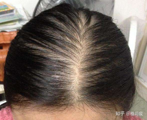 一,脂溢性脱发的症状和原因