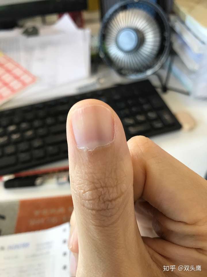 指甲上有一条淡淡黑线,怎么回事?两年了.