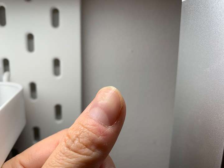 大拇指指甲凹凸不平有凸起的横纹和凹陷很多年了也没有其它问题去检查