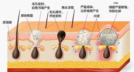 所谓黑头,就是肌肤角质栓塞的一种情况,由于皮脂腺分泌过剩的油脂