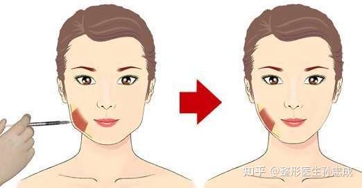 咬肌大怎么瘦下去?