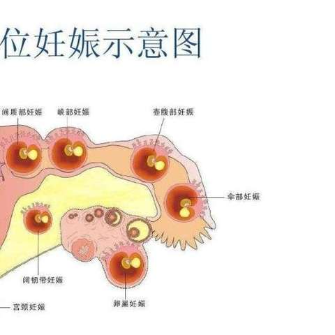 阻碍孕卵正常运行,使之在输卵管内停留,着床,发育,导致输卵管妊娠流产