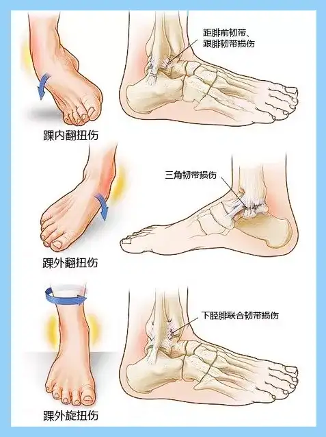 脚踝关节是人体中的一个比较复杂的关节,关节周围附着着韧带和肌肉