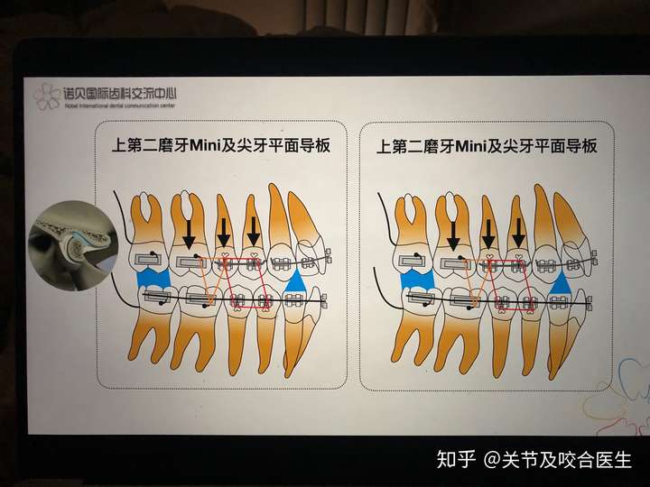 深覆合做矫正都要带平导吗?