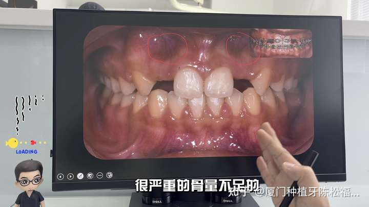 比如下面的这个案例 这个患者的侧切牙先天缺失,根据牙龈处的明显凹陷