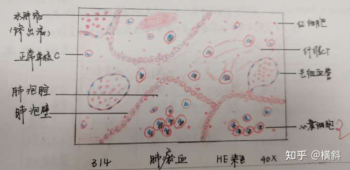 急性蜂窝组织性阑尾炎