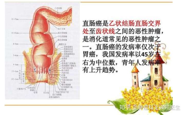 直肠癌一发现就是晚期这四个症状需要注意