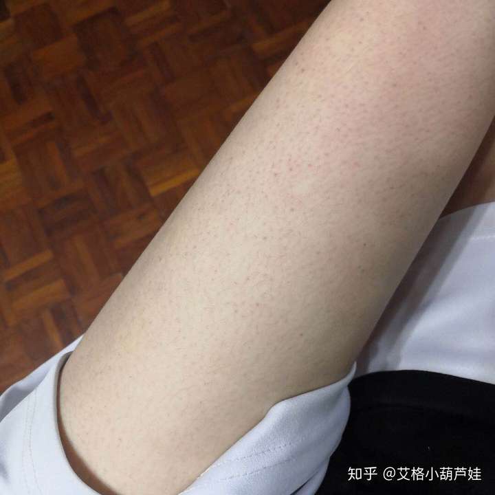 毛囊角质化(鸡皮肤)是否无法改善?