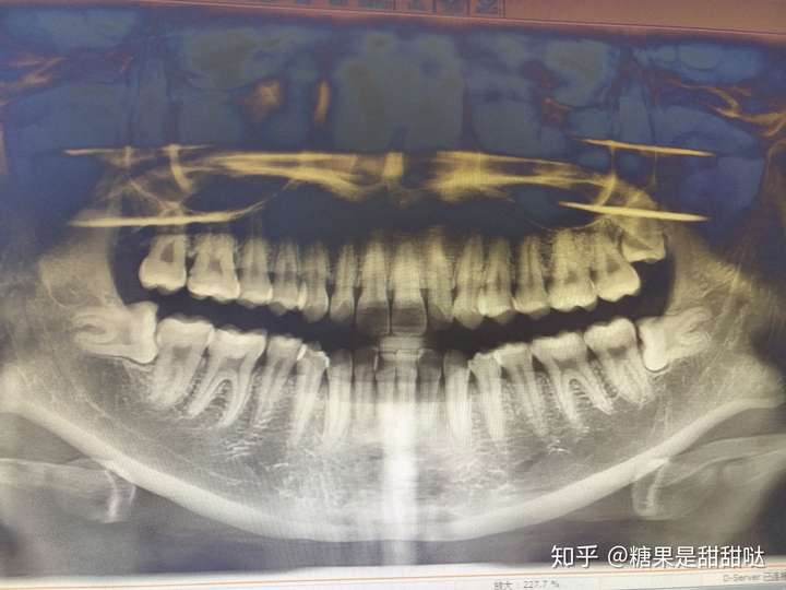 拔横着长的智齿是怎样的体验?