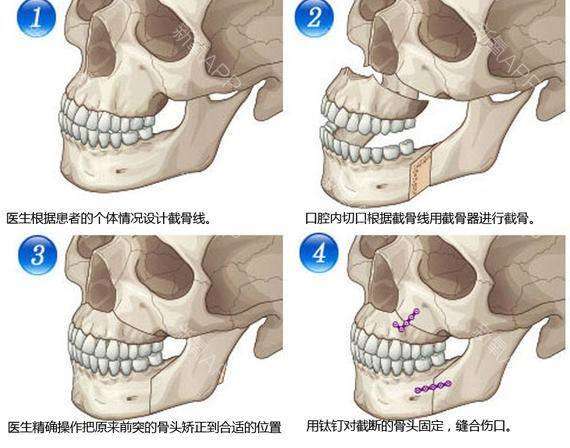 甚至需要下颌骨牵张成骨术