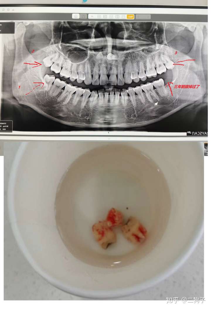 我一次拔了剩下的三颗智齿,两颗上颌的比较顺利几秒钟完事, 下颌的那