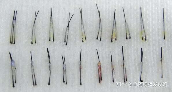 毛囊器械越好,手术可以做得越精密,取毛囊时对毛囊的损伤会越小,这样