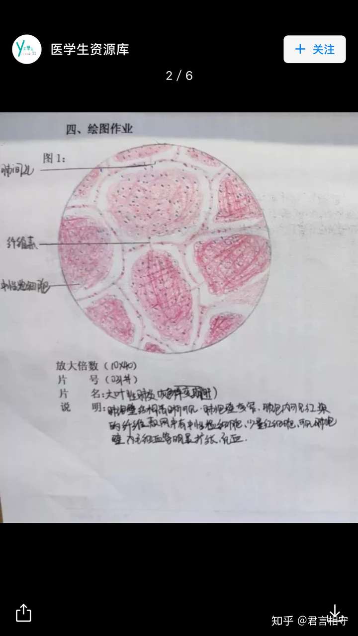 红蓝铅笔大叶性肺炎图怎么画?