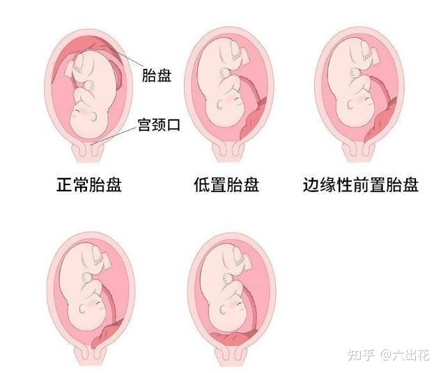大家第一次怀孕,胎盘会低置吗?