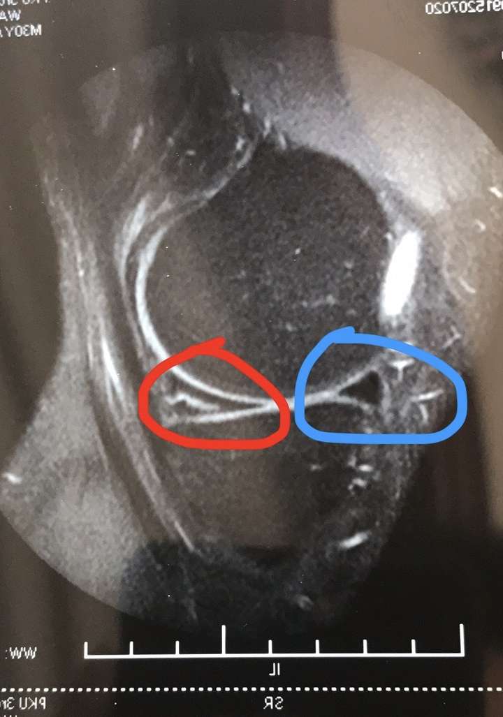 后来工作以后照过一次核磁,内侧半月板后角撕裂,但是完全不影响我的