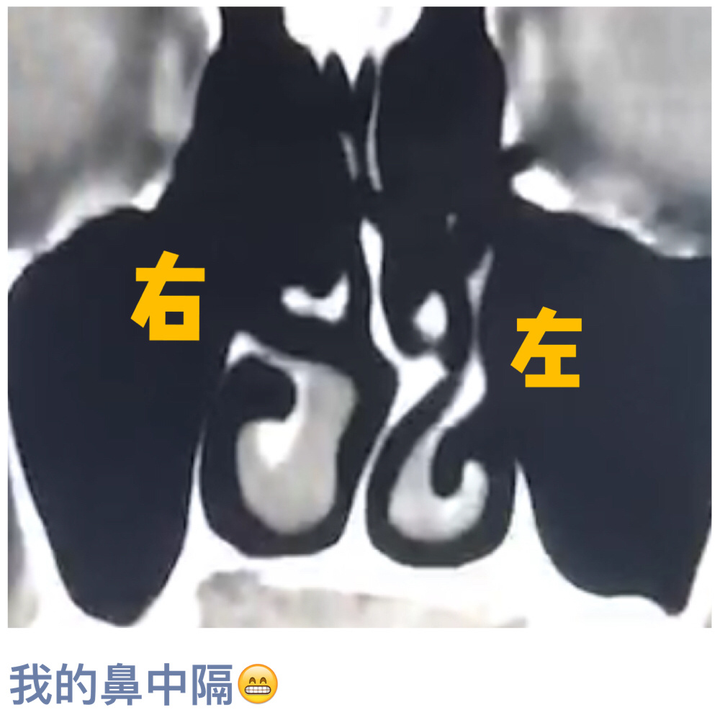 鼻中隔偏曲对人体究竟有多大影响?